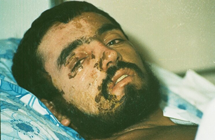 PHOTO: Victims of Chemical Weapons